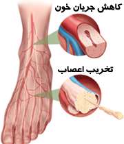 آسیب پا در نوروپاتی دیابتی