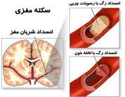 سکته مغزی