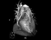 volume rendered ct angiography of coronary arteries