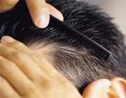 علل ریزش مو چیست؟