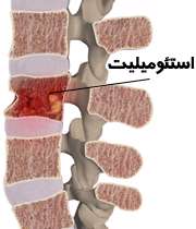 عفونت استخوان (استئومیلیت)