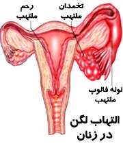 التهاب لگن در زنان