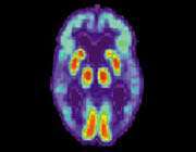 pet scan of an old brain within mild cognitive impairment (mci)