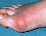 inflammation and swelling of a toe joint caused by gout