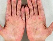 ضایعات پوستی در بیماری لوپوس