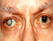 استخدام الاسبرين يوميا خطر على العينين