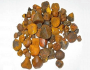 kidney stones, gallstones linked