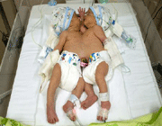 iranian conjoined twins separated
