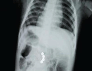 an x-ray showing four magnets attached to each other inside a child’s abdomen