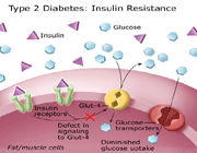 диабет 2 типа 