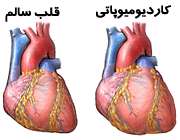 کاردیومیوپاتی (بیماری عضله قلب)