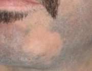 ریزش موی صورت در مردان