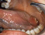 علائم سرطان دهان چیست؟ 1
