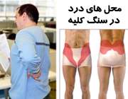 درد سنگ کلیه
