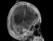 a skull x-ray of a patient with deep brain stimulation device