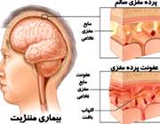 بیماری مننژیت