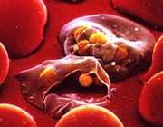 گلبول های قرمز خون در بیماری مالاریا