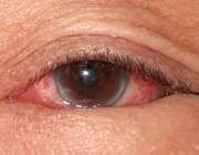انتروپیون چشم