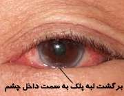 انتروپیون یا برگشت لبه پلک به داخل چشم