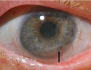بیماری کراتیت یا التهاب قرنیه چشم