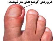 فرو رفتن گوشه ناخن پا در گوشت