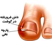 درمان فرو رفتن گوشه ناخن پا در گوشت
