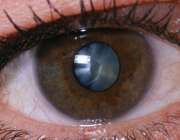 آب مروارید چشم