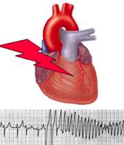 اختلال ضربان قلب