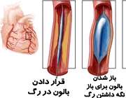 آنژیوپلاستی قلبی