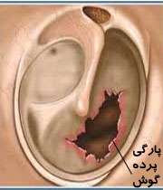 پارگی پرده گوش