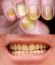 زردی ناخن و دندان در سیگاری ها