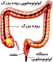 آزمایش کولونوسکوپی برای بررسی روده بزرگ