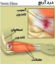 درد خارج آرنج دست