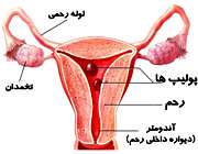 پولیپ‌های رحم در خانم‌ها