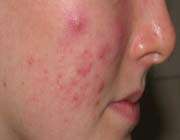 natural skin virus can fight against acne bacteria