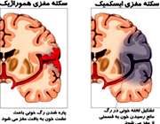 سکته مغزی