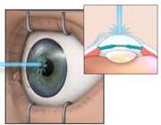عمل لیزیک چشم؛ مفید یا مضر؟ 1