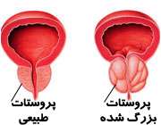بزرگ شدن پروستات در مردان