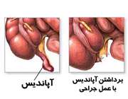 عمل جراحی آپاندیس