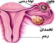 بارداری خارج رحم