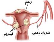 فیبروم رحم