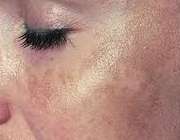 درمان لک های پوستی سفید قهوه ای تیره