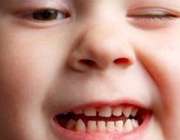 دندان‌ قروچه در کودکان