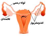 اندومتریوز