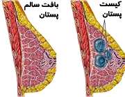 کیست‌ پستان