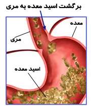 ریفلاکس