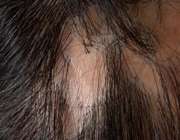 درمان ریزش مو در لوپوس