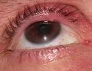 درمان ريزش مژه چشم
