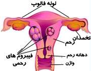 فیبروم رحم