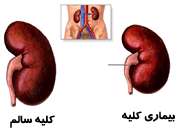 بیماری کلیه